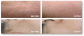 Laser Hair Removal Procedure to Stop Hair Growth