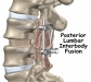 Cost Effective and Successful Spinal Fusion Surgery India