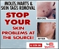 How To Remove Moles, Warts Or Skin Tags Permanently