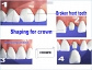 Dental Implants in Patiala