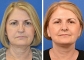 Mini Face Lift Los Angeles