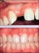westchester dental implants