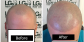 Get Best Bald Treatment In Birmingham