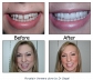 For Porcelain Veneers and Lumineers in Chicago Call us Today