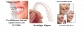 Invisalign Braces - Dentist - Chicago