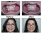 Teeth Veneers Chicago IL - Dentist - Chicago