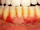 Natural Solution To Horrible Gums, Teeth and Bad Breath