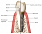 affordable dental implants treatment in india, niegiria,Kenya,libia,afganistan,iraq,egypt,ireland,
