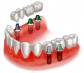 dental implant course in india,implant dentist in india,usa,uk,dubai, australia,france,south africa,