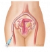 Cost of Myomectomy surgery in India