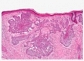 signs of skin cancer