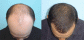 Plastic & Hair transplantation surgeries at Ambrosia Clinic, Hyderabad, India