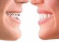 Best Dental Implant Treatment 