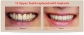 Cost of tooth implant