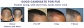 Hair transplant treatment in India
