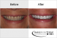 Teeth Straightening