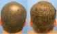 Hair Transplant Surgery Results - Dr. Wong