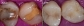 Composite Metal-free Fillings at North Hollywood CA