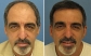 Hair Transplant Surgery in British Columbia