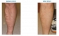 Affordable Treatment for Spider Vein Removal