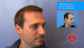 Hair Transplant Before and After