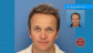 Hair Transplant Before and After