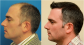 Hair Transplant Results by Hasson & Wong