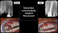 Sinus Lift and Immediate Implant in Fremont