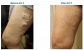 Atlantic Vein Clinics Providing Best Endovenous Laser Treatment for Spider Veins