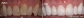 Teeth Whitening in North Hollywood