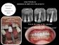 Dental Implants in Fremont CA
