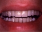 Recommended Teeth Whitening Williamsburg - 23188- Dr. Peter Evans  