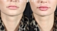 Filler for lips